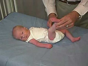 neurology exam: newborn-abnormal: Tone - Leg Traction