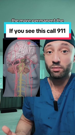 This is a TIA, which is a short lived stroke. Be aware of the signs. #stroke #strokesurvivor #neurosurgery #timeisbrain #transientischaemicattack #healthandwellness #brainhealth