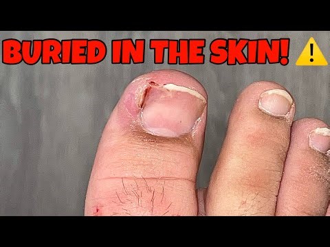 Extreme Ingrown Nail Extraction – Instant Relief!