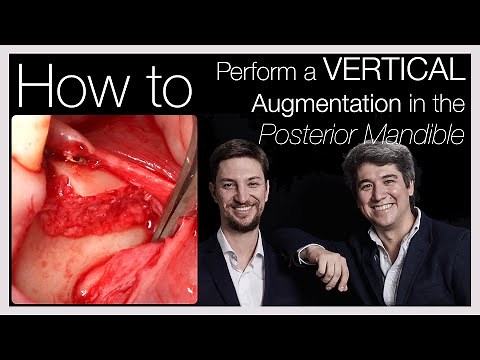 ❗️[Khoury Technique]: Vertical Bone Augmentation in the Posterior Mandible ☄️ - Advanced Techniques