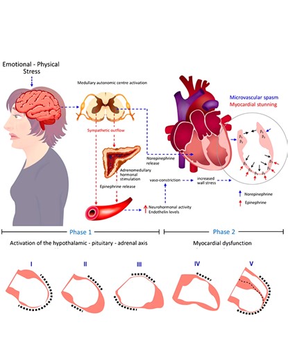 157K views · 1.2K reactions |  Takotsubo Cardiomyopathy: The Broken...