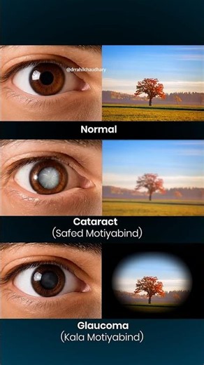 Normal Vision vs Cataract vs Glaucoma