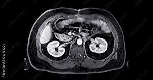 MRI of the upper abdomen axial view is a non-invasive imaging technique providing detailed visuals of organs like the liver, pancreas, and kidneys.