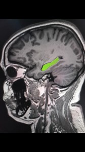 #hippocampus #mri #MRI | CT Scan and MRI study