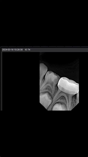 Tony Liera on Instagram: "Seguimiento de 1a 9m y va camino a su exfoliación. Pulpectomía, elevación de margen, core y Table top. En la búsqueda de alternativas restauradora estéticas aquí es donde más cómodo me siento, prefiero la reconstrucción antes que la corona prefabricada por 2 razones; 1. Evitó el desgaste excesivo de un diente que ya esta severamente destruido. 2. Mejores contactos oclusales. Cuándo optar por una coronas prefabricadas? 👍 Tiempo de exfoliación mayor a 2 años, la evidenci