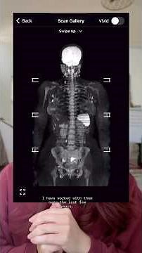 Welp, here are the results from my full body MRI that scanned me for over 500 diseases 🧠 #health