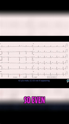 Sinus pause or sinus block? Decoding this irregular rhythm... SA node taking a break! 🧐 #EKG #NurseLife #MedTok #Healthcare #SinusPause