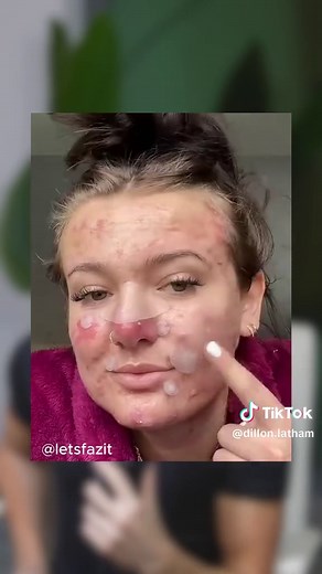 How to Remove Pimples Safely and Effectively