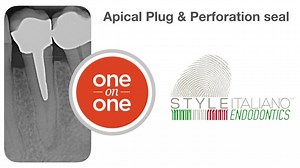 9.8K views · 59 reactions | APICAL PLUG & PERFORATION SEAL by Riccardo Tonini Map system and PD MTA for solving this difficult case! A perforation,at the middle of the root,caused by an invasive post space preparation,has been sealed by MTA and for convenience an Apical Plug has been performed with the same material. | Style Italiano Endodontics | Facebook