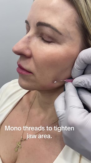 Mono threads are a great way to stimulate collagen production. Book your treatment today ph: 0466051651
