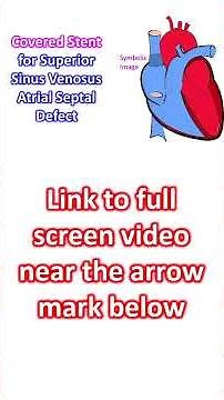 Covered Stent for Superior Sinus Venosus Atrial Septal Defect