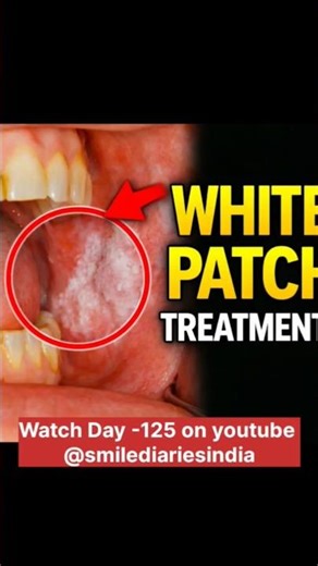 Day-147 White Patch in Mouth? Don’t Ignore This | Complete Treatment Plan in Day-125.