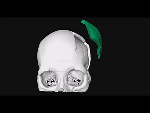 Video Tutorial: Semi-Automatic Planning of Cranial 3D Implants under MeVisLab