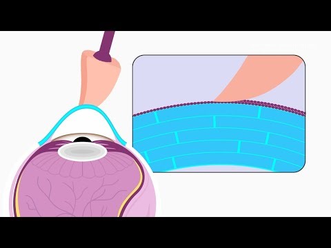Corneal Crosslinking: Indications and Step-by-Step Procedure Overview