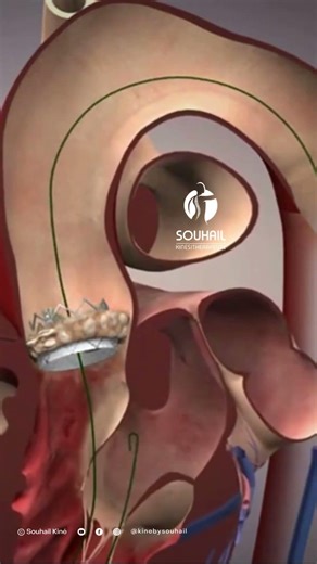Replacing a heart valve without opening the chest 😱 #shorts #health #pain #fblifestyle