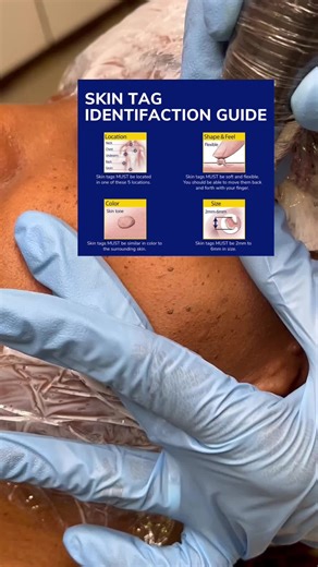 Understanding Skin Tags: Causes and Treatment Options