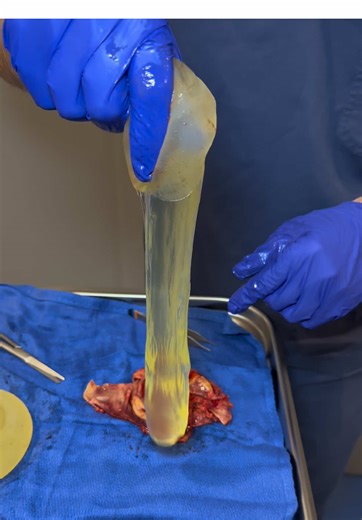 Removing Old Cochlear Implants: A Surprising Surgery