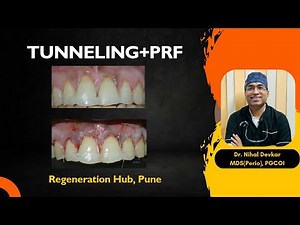 Tunneling Technique + PRF: PRF in root coverage | Regeneration Hub Pune