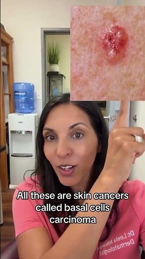 All these are skin cancers!! 😥basal cell carcinomas! #bcc #skincancer #dermatology