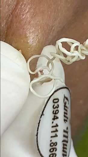 Shorts acne treatment #06 #acne #acnetreatment #mun #bigacne #acneremove #gloves #nanmun #spalinhmun