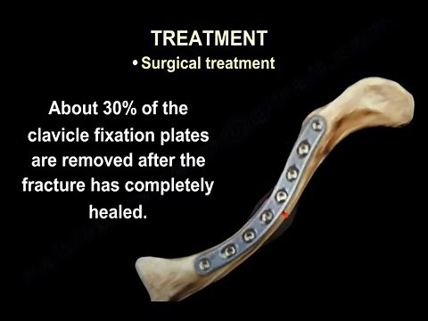 Clavicle fracture fixation , a case presentation with the bone almost piercing the skin.