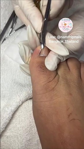 Relieving Ingrown Toenail Removal and Foot Care