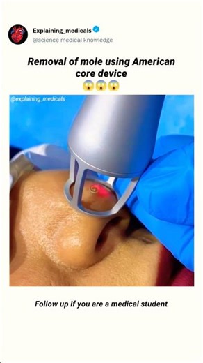 Removal of mole using American core device#medical #pharmcist#medicines #pharmcology #eyes
