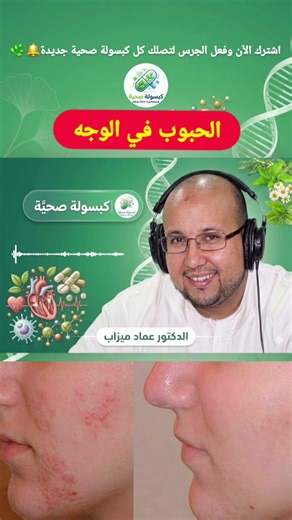 وصفة الحبوب في الوجه من عند الدكتور عماد ميزاب