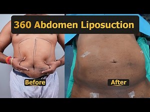 360 Abdomen Liposuction cost | 360 Abdomen Liposuction | 360 Abdomen Liposuction Video