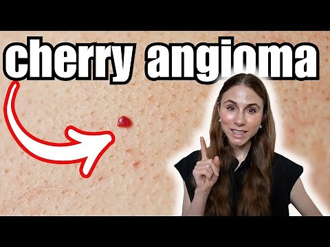 Cherry Angiomas: Everything You Need To Know 🩺