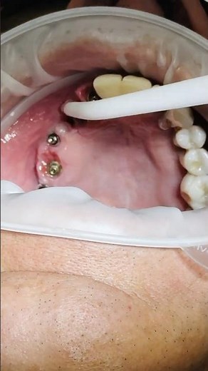 Dental implants Process: Before & After Transformation