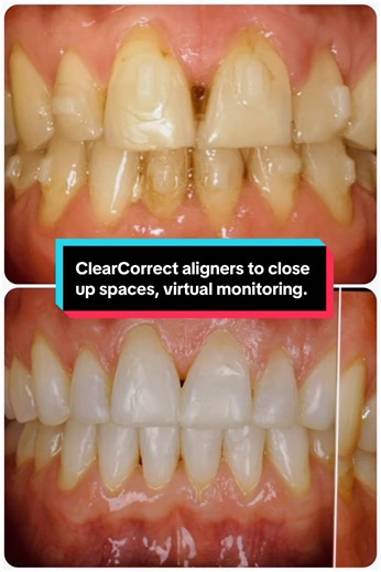 CLOSING UP SPACES BETWEEN TEETH, WHAT CAN BE DONE WITH ALIGNERS? Our patient wasn’t sure if teeth straightening would be powerful enough to fully correct the gaps in his upper teeth. We carefully planned his teeth straightening journey, to ensure we not only closed all spaces, but also aligned all his other teeth, to provide a beautiful aligned arch form. Progression was checked throughout by virtual monitoring. We have straightened his teeth using ClearCorrect aligners, and have given him a smi
