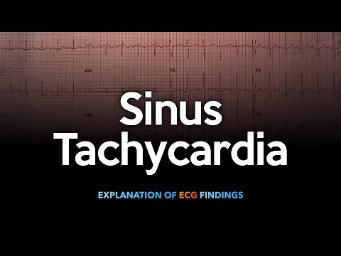 Sinus Tachycardia ECG