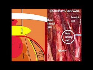 Pelvic Sidewall Avascular Spaces Animation • Video • MEDtube.net
