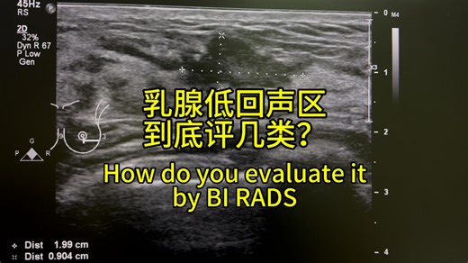 乳腺结节，BI RADS评几类？想学习超声的，加，薇，信，rich86669。#超声 #乳腺结节