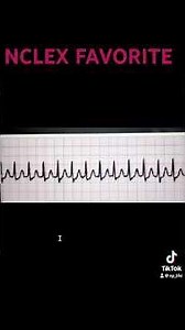 If AFib vs SVT vs VT confuses you- Watch This