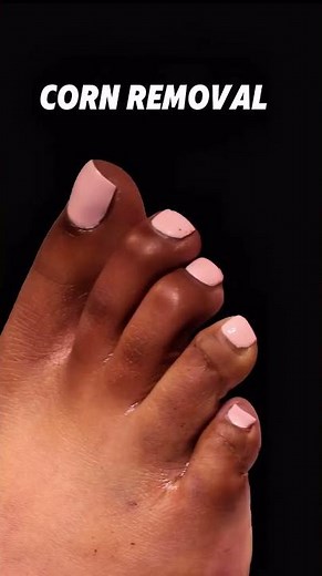 CORNS ON TOES REMOVAL | Before and After