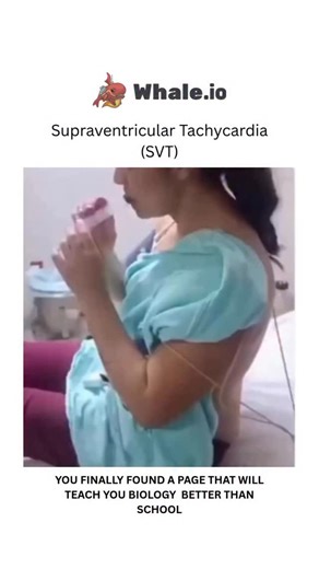 BIOLOGY | MEDICAL | HEALTH on Instagram: "Supraventricular tachycardia (SVT) is a type of arrhythmia, or irregular heartbeat, where the heart rate is abnormally fast, typically exceeding 100 beats per minute. It originates in the heart’s upper chambers (atria) or the area near the atrioventricular (AV) node. This rapid heart rate can be triggered by faulty electrical signals in the heart, leading to a series of early beats that disrupt the normal rhythm. Dm for credit or removal "
