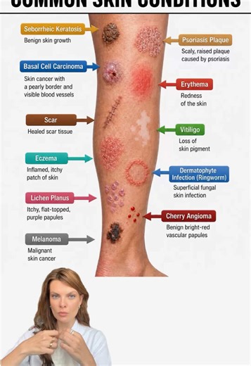 ⚠️ Do not self diagnose! ⚠️ although these images are fairly representative, many skin conditions can look similar, and diagnosis often requires examination (sometimes with dermoscopy or even a biopsy). For example, not every dark mole is melanoma, and not every red scaly patch is eczema or psoriasis! If you notice something unusual on your skin seek professional help. #skinhealth #healtheducation #skinconditions