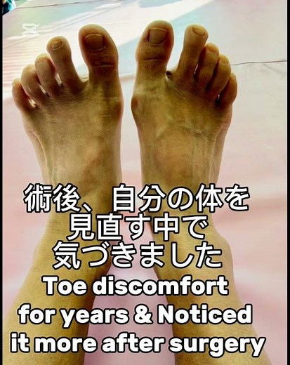 膝手術後 外反母趾と靴が合わない現実 Post-op Knee Journey IBunions & Shoe Pain