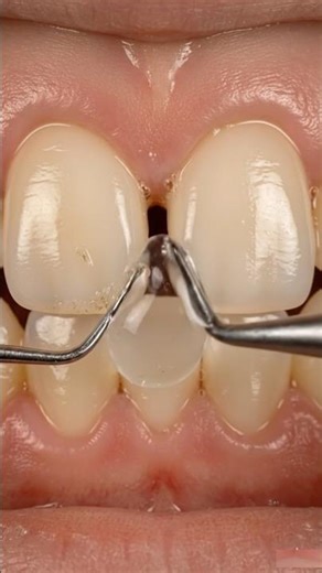 Deep Caries to Veneers: Anterior Tooth Transformation | #dentist #toothcraft #asmr #satisfying