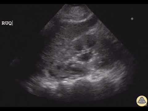 Mild Hydronephrosis from an Ureteral Stone