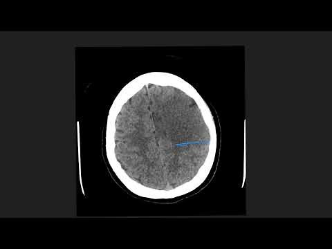 Cerebral Oedema; Cytotoxic or Vasogenic. Can you tell the difference?