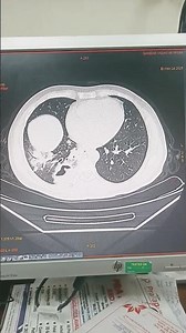 axial view of HRCT thorax find the diagnosis #radiology