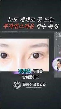 부자연스러운 쌍꺼풀, 실제 사례로 보는 비교!! #눈재수술 #쌍수재수술 #쌍꺼풀재수술 #쌍커풀재수술 #눈재수술유명한곳 #절개눈재수술 #은하수성형외과눈재수술 #은하수성형외과후기