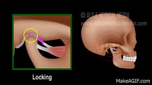 Temporomandibular Joint (TMJ) Anatomy and Disc Displacement Animation on Make a GIF