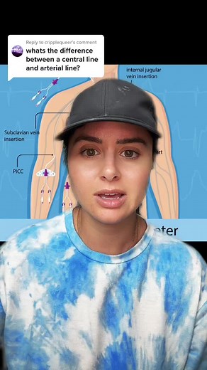Arterial Line vs Central Line: Understanding the Key Differences