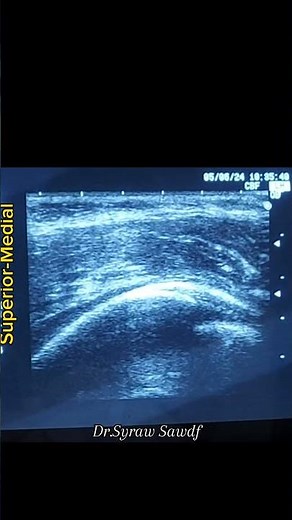 SIFI (supra-inguinal Fascia iliaca) block usg guided by Dr.Sairah Sadaf