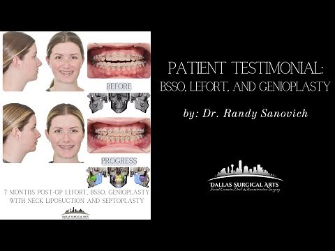 Patient Testimonial: BSSO, LEFORT, and Genioplasty by: Dr. Randy Sanovich
