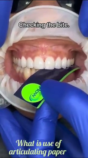 Articulating paper vs. digital occlusion analysis??? how to use articulating paper in dentistry 🤯🤔🦷